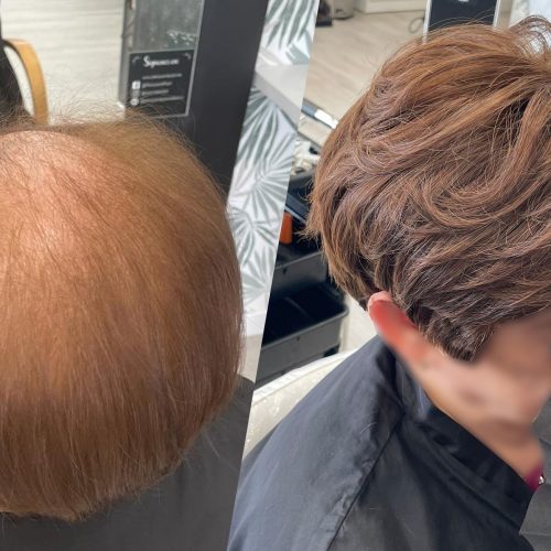 Microlineas Alopecia Frontal Peluquería Hairdreams